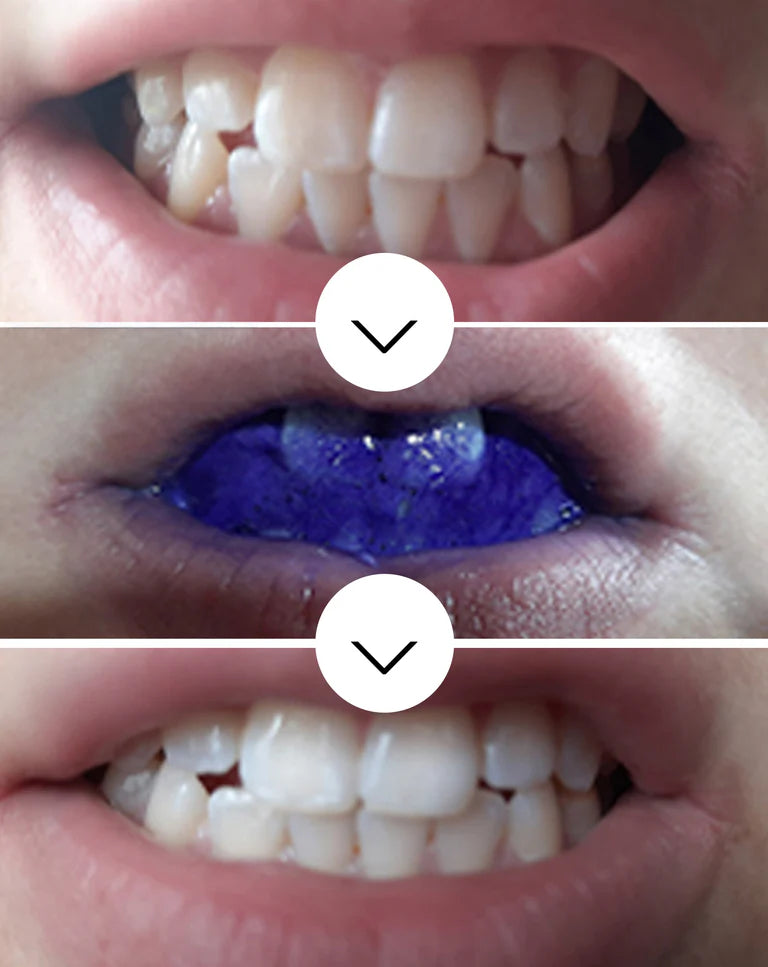 Sérum Blanchissant ModerneSmile™ V34 - éclat instantané pour un sourire radieux